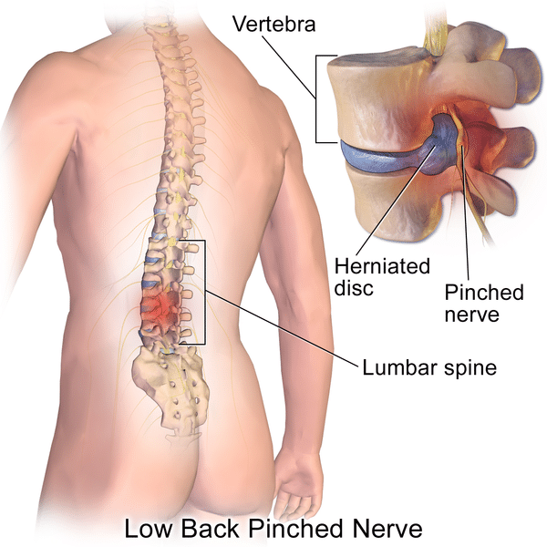 Herniated Lumbar