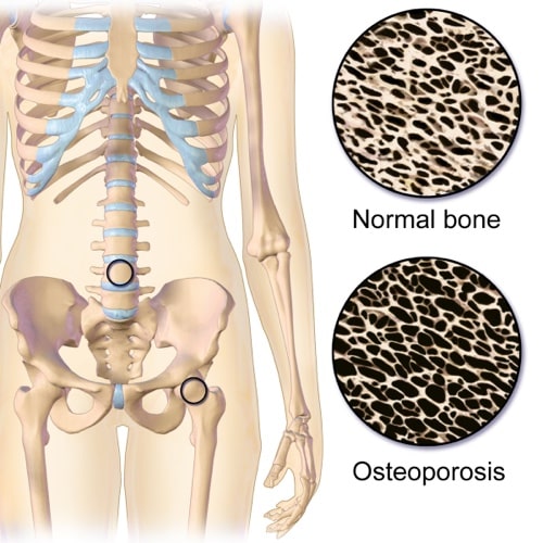 What is osteoporosis