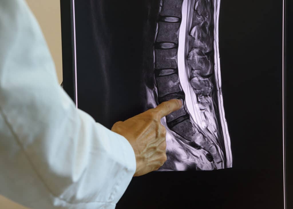 Doctor pointing at MRI of lumbar spondylosis on computer screen.