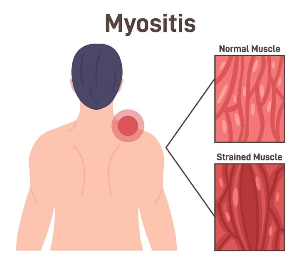 Person Having Neck And Shoulder Pain. Trigger Point In Muscle