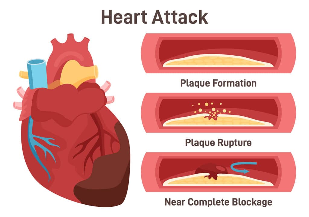 Heart attack mechanism. Damaged heart, blood vessel section