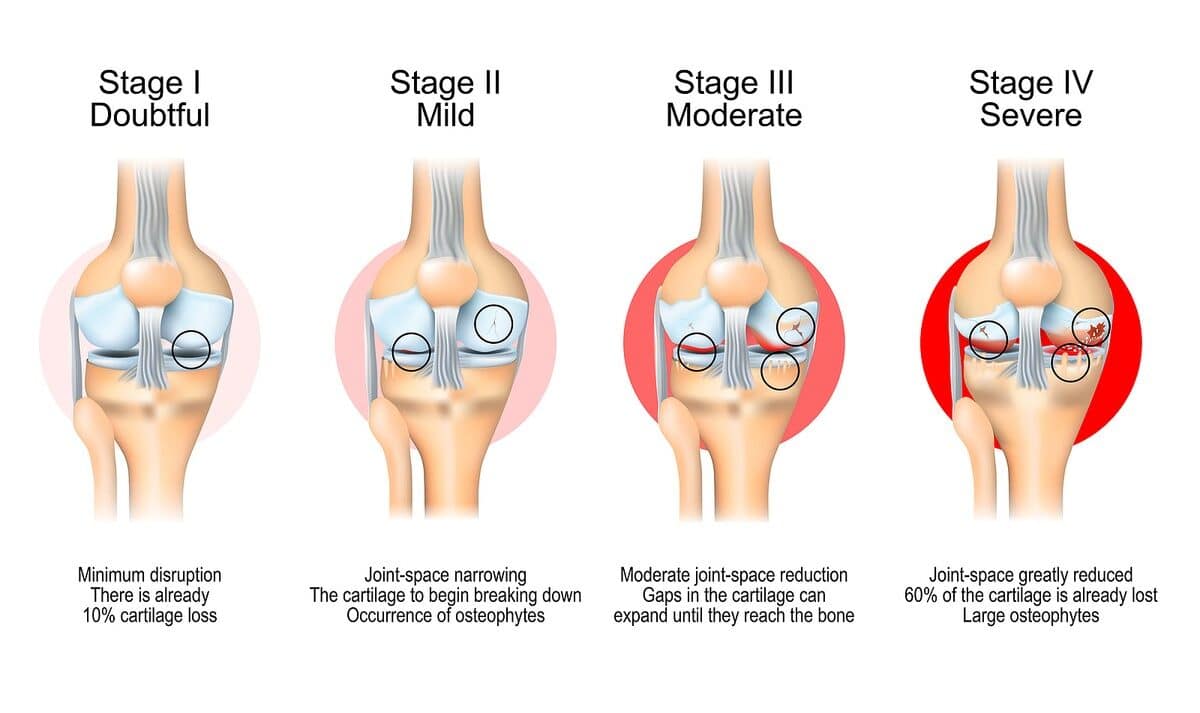 Stages of knee osteoarthritis. From Minimum disruption to lost a cartilage and joint-space reduction. Anatomy of knee joint.