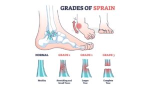 Grades of an ankle strain