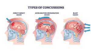 Types of concussions