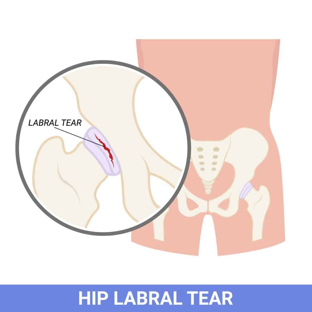 The labral of hip that tear and injury